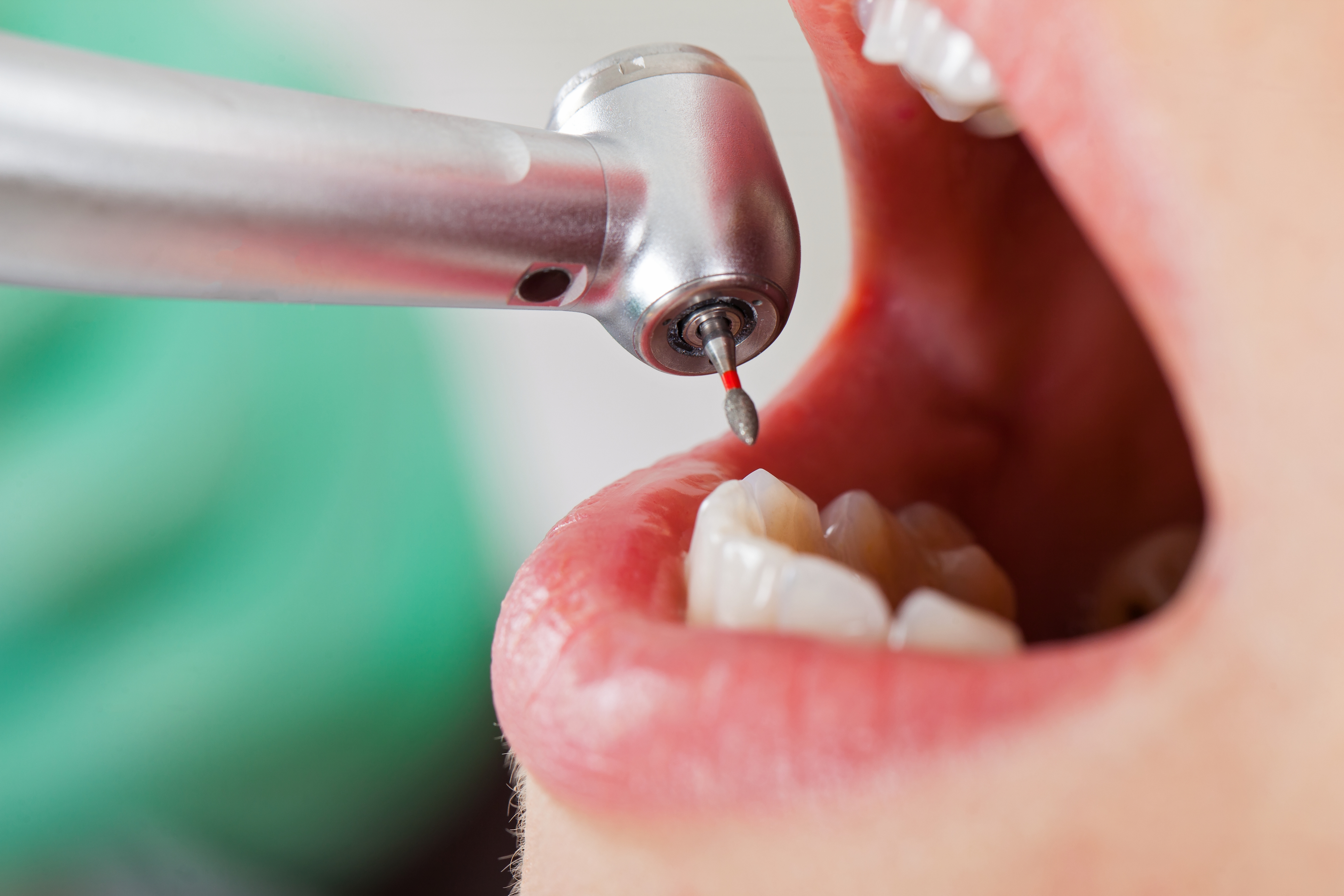 CASE STUDY: Patient Aspirates Foreign Material During Dental Restoration Procedure