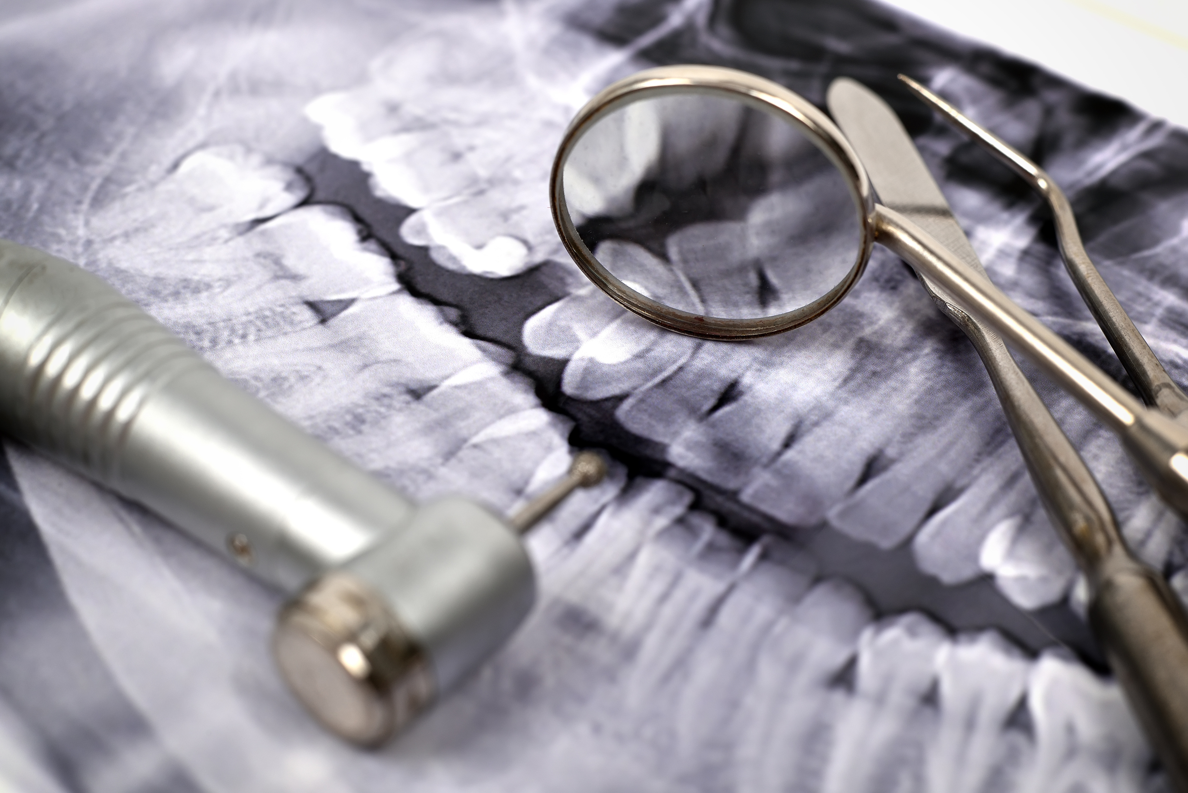 CASE STUDY: Insufficient Imaging and Poor Communication Complicate Tooth Extraction